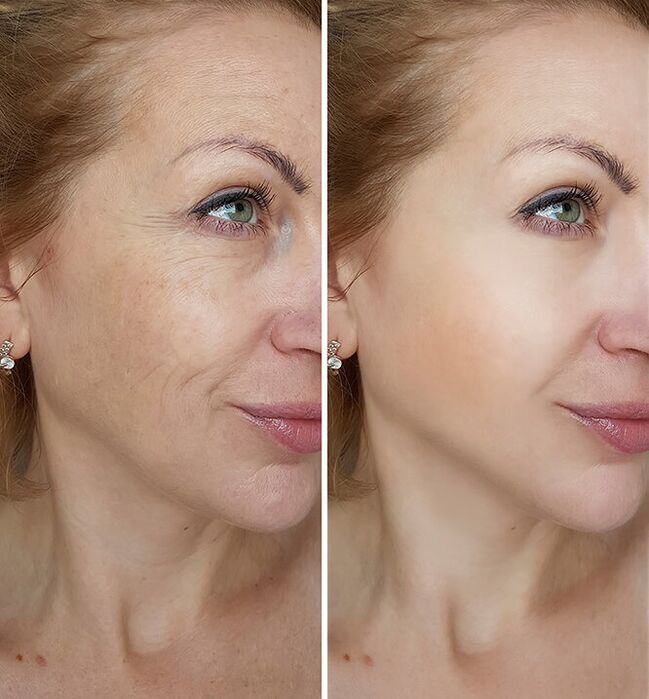 How Yenki Derm rejuvenated Maria from Krakow