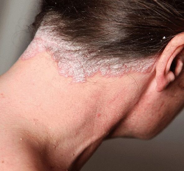 How to treat Psoriasis