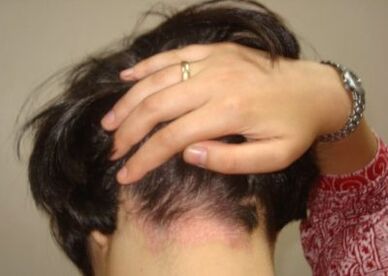Psoriasis in the head
