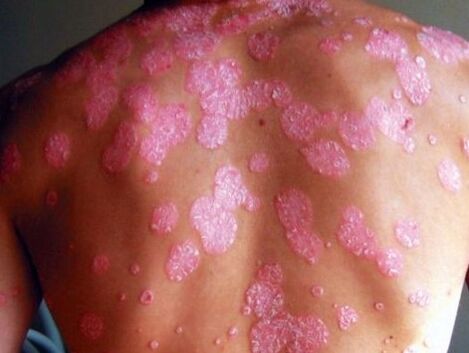 Psoriad disease