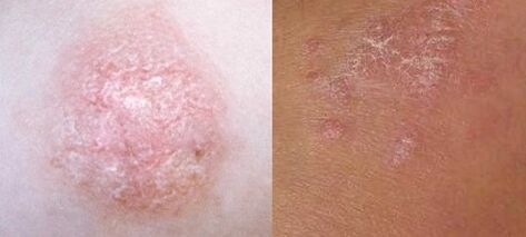 At the initial stage psoriasis